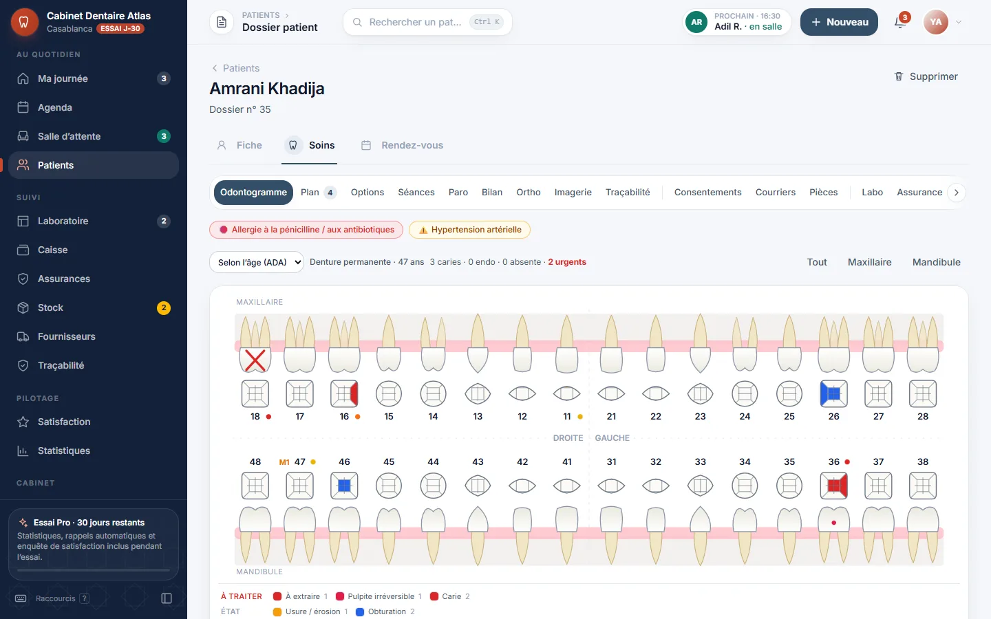 Odontogramme anatomique DentistePro : arcades maxillaire et mandibulaire, caries, obturations, dent à extraire et légende